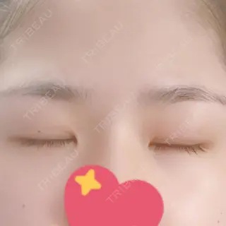 3日目の経過画像（2枚目）