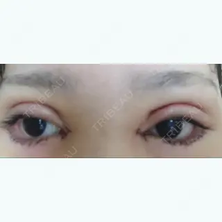 3日目の経過画像（1枚目）