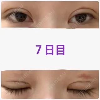7日目の経過画像（1枚目）