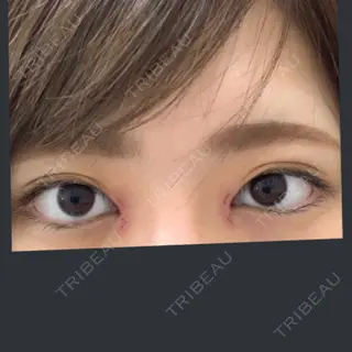 5日目の経過画像（1枚目）