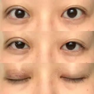 5日目の経過画像（1枚目）