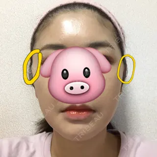 28日目の経過画像（1枚目）