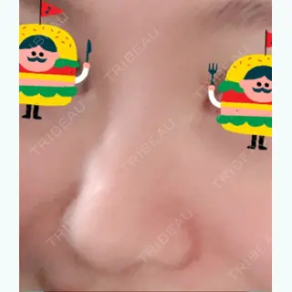 0日目の経過画像（1枚目）