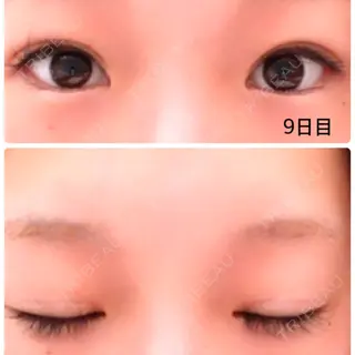 9日目の経過画像（1枚目）