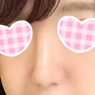 0日目の経過画像（1枚目）