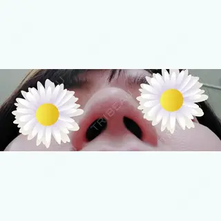 31日目の経過画像（3枚目）