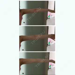 43日目の経過画像（2枚目）