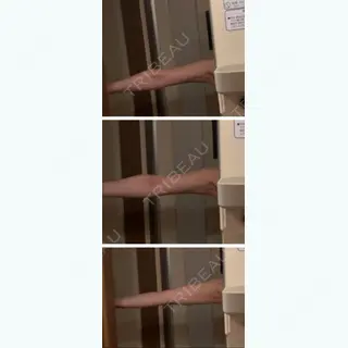 36日目の経過画像（3枚目）