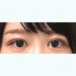 41日目の経過画像（1枚目）