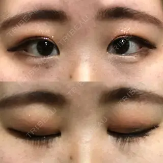2日目の経過画像（1枚目）