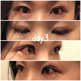 3日目の経過画像（1枚目）