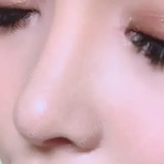 35日目の経過画像（2枚目）