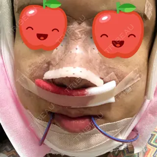 0日目の経過画像（1枚目）