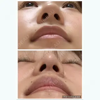 74日目の経過画像（2枚目）