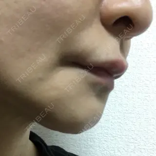 79日目の経過画像（2枚目）