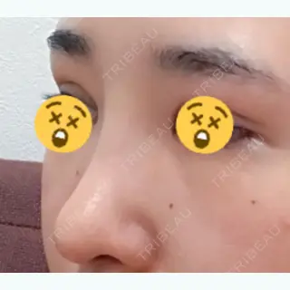31日目の経過画像（2枚目）