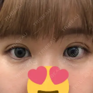 5日目の経過画像（1枚目）