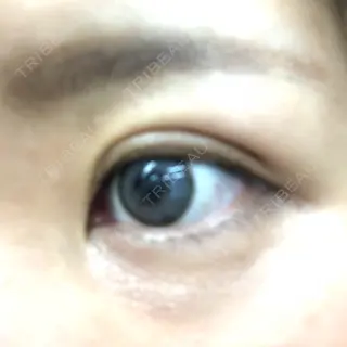 5日目の経過画像（3枚目）