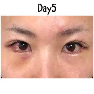5日目の経過画像（1枚目）