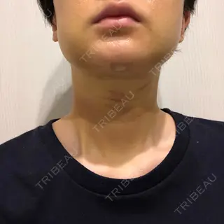 2日目の経過画像（3枚目）