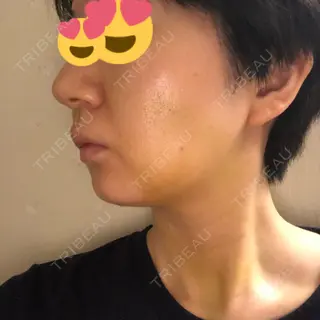 7日目の経過画像（1枚目）