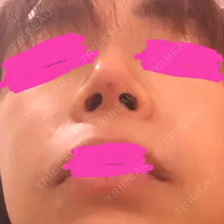 1日目の経過画像（1枚目）
