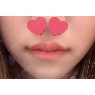 0日目の経過画像（1枚目）