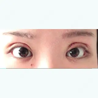 6日目の経過画像（1枚目）
