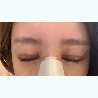 4日目の経過画像（2枚目）