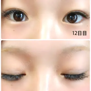 12日目の経過画像（1枚目）