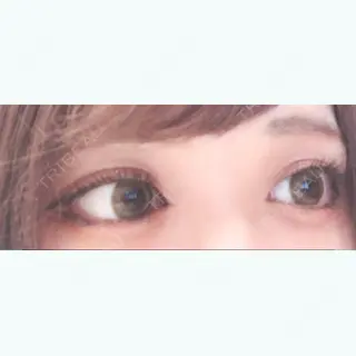 12日目の経過画像（3枚目）