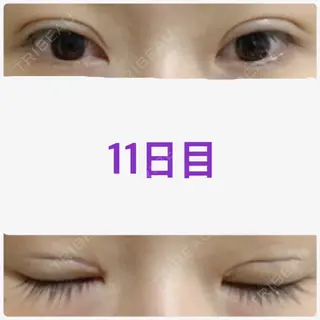 11日目の経過画像（1枚目）