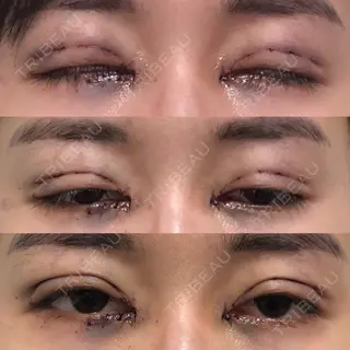 0日目の経過画像（1枚目）