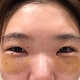 0日目の経過画像（1枚目）