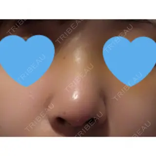 3日目の経過画像（1枚目）