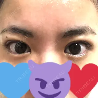 2日目の経過画像（1枚目）