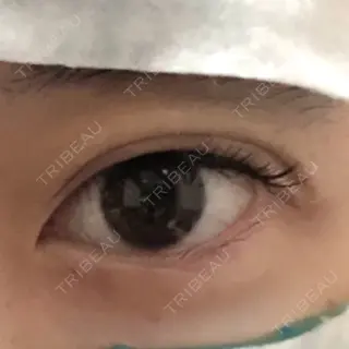 3日目の経過画像（1枚目）
