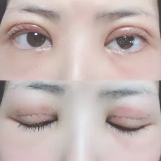 2日目の経過画像（1枚目）