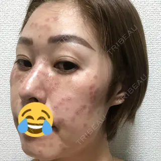 0日目の経過画像（2枚目）