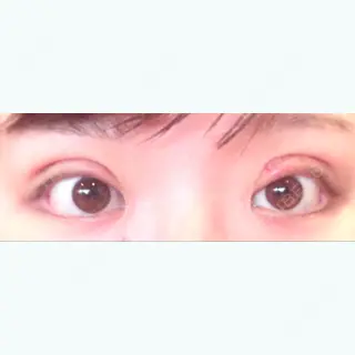 7日目の経過画像（1枚目）