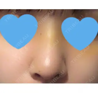 4日目の経過画像（1枚目）