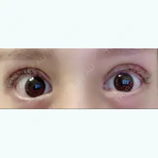 5日目の経過画像（3枚目）