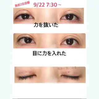 2日目の経過画像（1枚目）