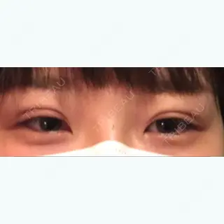 0日目の経過画像（1枚目）