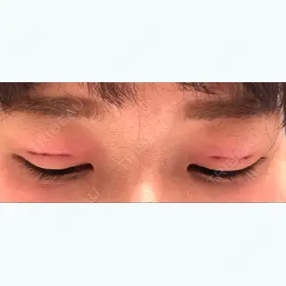 0日目の経過画像（2枚目）