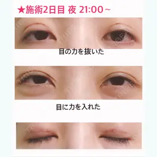 2日目の経過画像（1枚目）