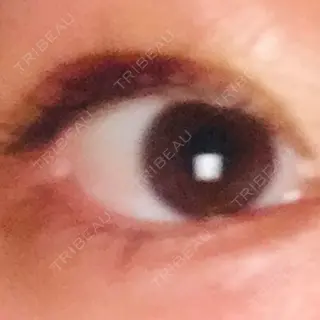 3日目の経過画像（1枚目）