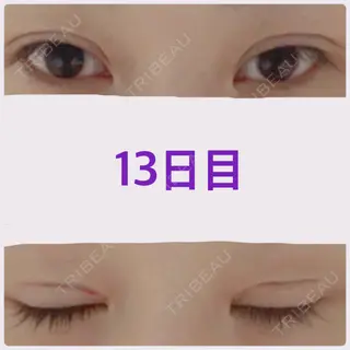 13日目の経過画像（1枚目）