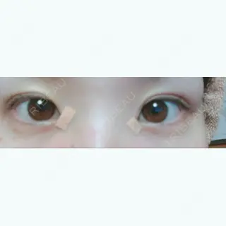 1日目の経過画像（1枚目）