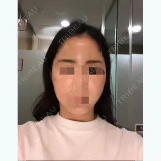 2日目の経過画像（1枚目）